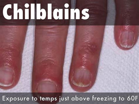 Chilblains Pernio & Chilblain Lupus Erythematosus - Causes & Treatment