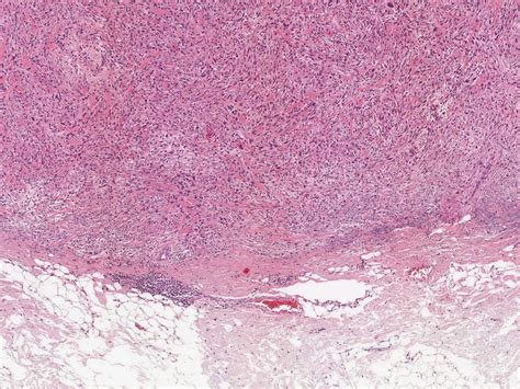 Dermpath Made Simple - Neoplastic: Atypical Fibroxanthoma