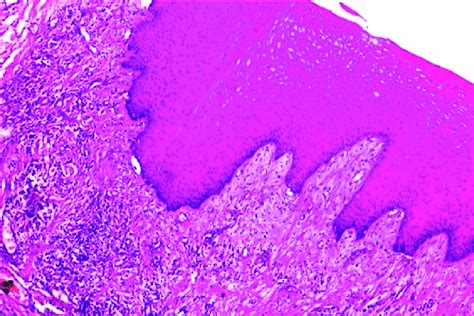 Gingival Hyperplasia Histology