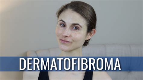 DERMATOFIBROMA: WHAT IS IT? HOW IS IT TREATED? | DR DRAY - YouTube