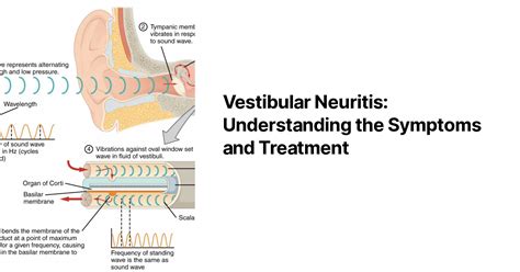 Vestibular Neuritis: Understanding the Symptoms and Treatment