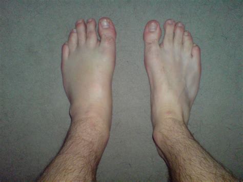 Torn Ligaments Are So Much Fun... | Here is my swollen foot … | Flickr