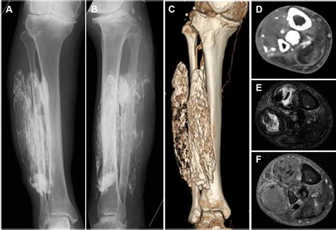 Figure 2 from Treatment of infected calcific myonecrosis with chronically discharging sinus ...