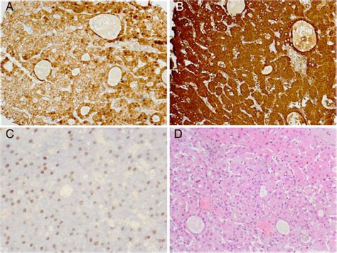 Liver biopsy: Small solid and glandular associations of hepatocytes... | Download Scientific Diagram