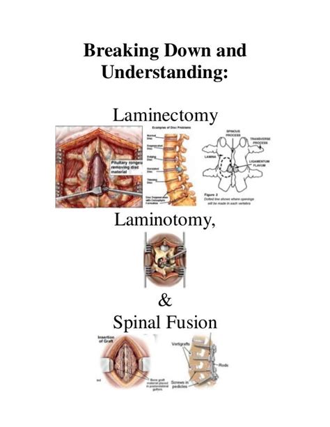 Breaking Down and Understanding Laminotomy, Laminectomy & Spinal Fusi…