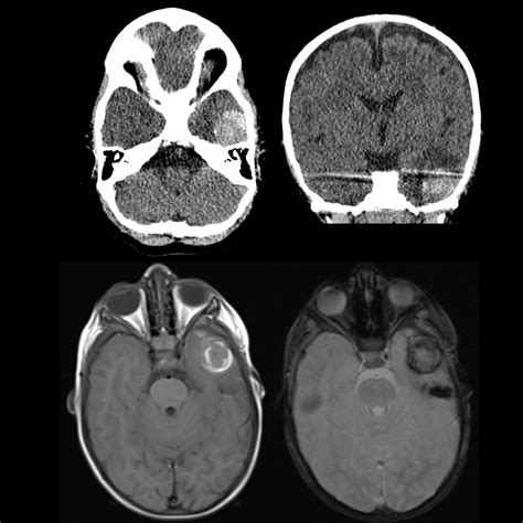 Pediatric Cavernous Malformation | Pediatric Radiology Reference ...