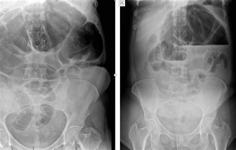 Cureus | Cecal Volvulus a Rare Cause of Intestinal Obstruction. A Case ...