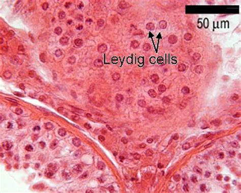 Leydig cell tumor causes, symptoms, diagnosis, treatment & prognosis