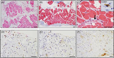 Histopathological findings of endomyocardial biopsy samples. An... | Download Scientific Diagram