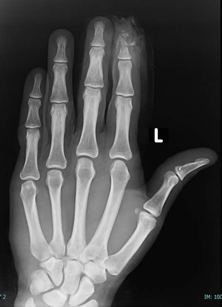 Distal Phalanx Fracture