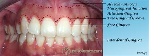 healthy gingiva | attached gingiva is non movable gingiva as the name indicates the ... | Dental ...