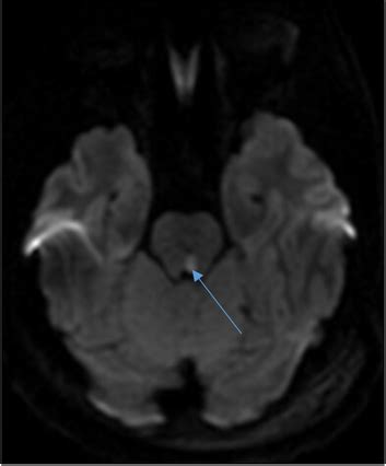 Traumatic unilateral internuclear ophthalmoplegia (INO). MRI brain w/wo ...