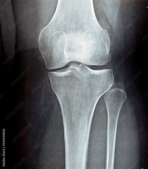 plain x ray on knee joint showing joint space narrowing and Subchondral Sclerosis on medial ...