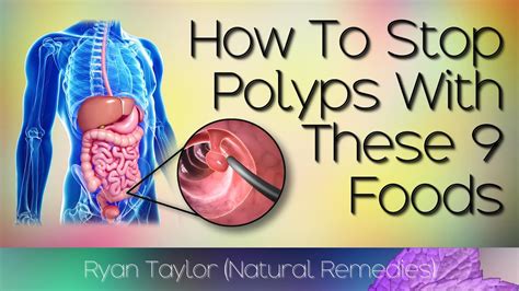 Foods That Prevent Polyps in the Colon - YouTube