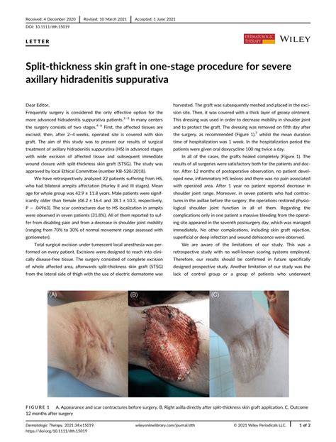 Split‐thickness skin graft ( STSG ) in one‐stage procedure for severe axillary hidradenitis ...