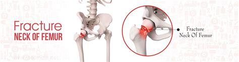 Fracture Neck of Femur - Risk factors, Types, Causes, Complications Management, Prognosis