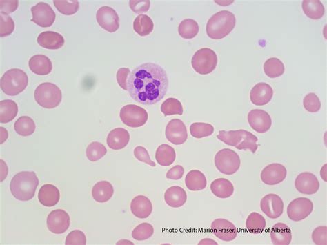 Hypersegmented Neutrophil - 2 | ERA