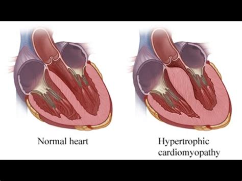 Hypertrophy Cardiomyopathy (Idiopathic Hypertrophic Subaortic Stenosis ...