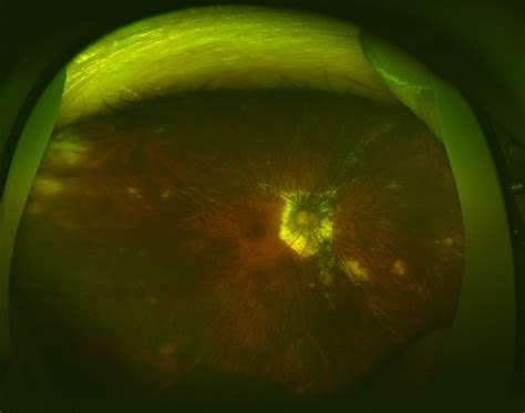 Multifocal Choroiditis and Panuveitis (MCP)(1) - Retina Image Bank