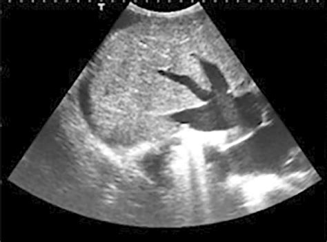 Abdominal ultrasound showing a heterogeneous liver with marked ...