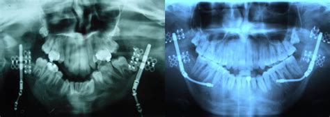 Distraction Osteogenesis | Maxillofacial Surgeons | Greenwich, CT