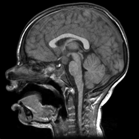 Hypothalamic hamartoma | Radiology Reference Article | Radiopaedia.org | Radiology, Glial cells ...