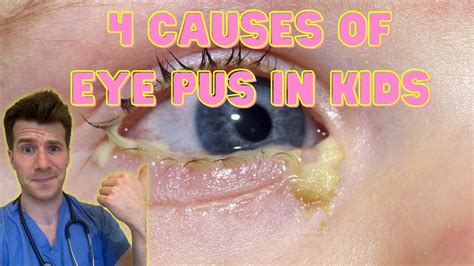 Doctor explains 4 causes of eye pus, discharge or sticky eyes in kids | Doctor O'Donovan - YouTube