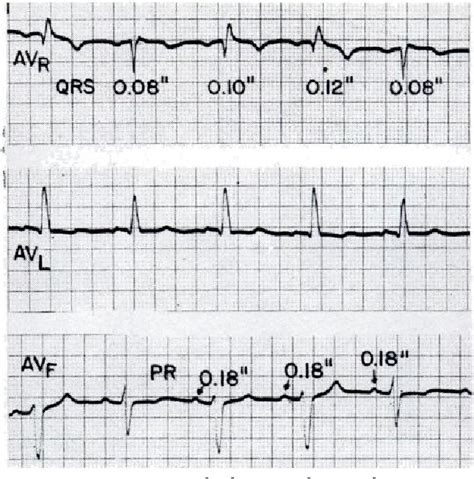 Figure 1 from Coexistent Wenckebach phenomenon in the distal branches ...