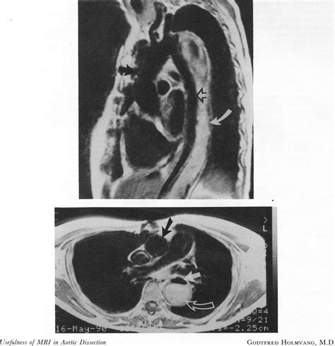 Usefulness of MRI in Aortic Dissection | NEJM