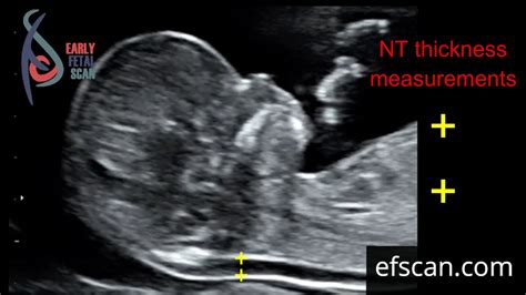 Nuchal translucency (NT) thickness measurement: for Early Fetal Scan Conference 2019 - YouTube