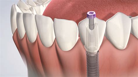 Full Dental Implants Cost | Dentist Rockville MD