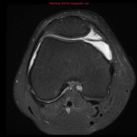 Viewing playlist: Medial patellar plica syndrome | Radiopaedia.org