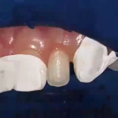 Treating microdontia with composite build-up | Dental Videos | Dental anatomy, Dental art, Smile ...