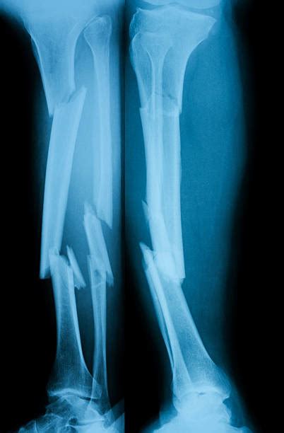 Best Broken Leg Xray Stock Photos, Pictures & Royalty-Free Images - iStock