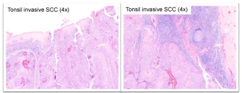 Squamous Cell Tonsil Cancer