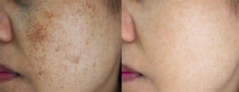 How to Reduce Melasma With Laser Treatment - Laser by Monica