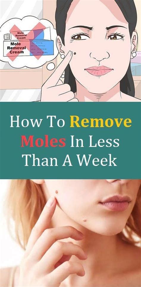 How To Remove Moles Cream - HOWTORMEOV