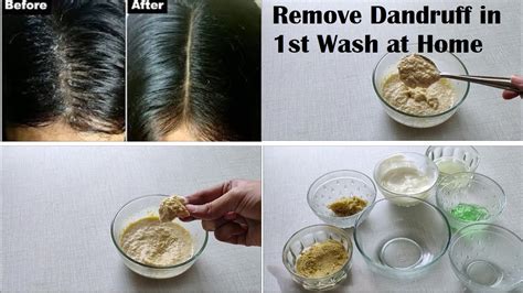 Best Remedy to Remove Dandruff Permanently and Naturally | How to Get Rid Of Dandruff in 1st ...