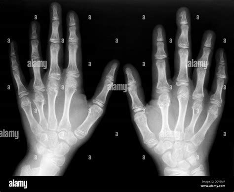 Hand Bones Anatomy