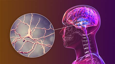 Is Parkinson's Disease More Prevalent than We Thought? A New Study Says Yes. - Brain Treatment ...