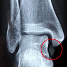 Deltoid Ligament Avulsion Fracture