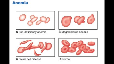 Chapter 13 Disorders of Red Blood Cells BIO216 - YouTube