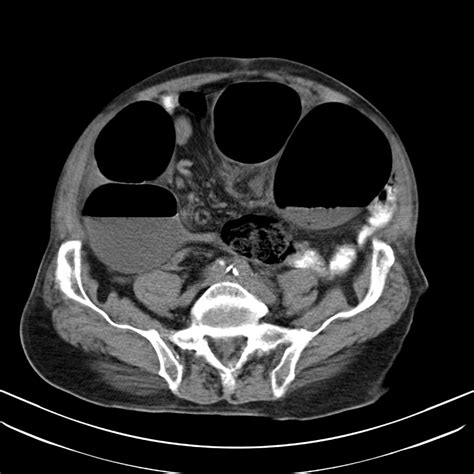 Sigmoid volvulus | Image | Radiopaedia.org