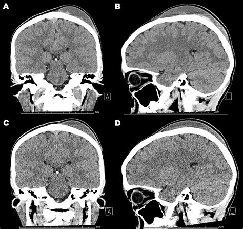 Cureus | Calvarium Subperiosteal Hematoma in a 12-Year-Old Boy