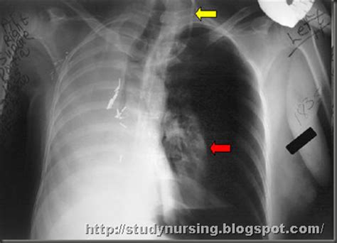 Pneumonectomy | studynursing