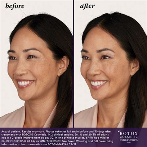 BOTOX® Cosmetic - Medicis﻿ | Las Vegas Medical Spa & Botox Clinic