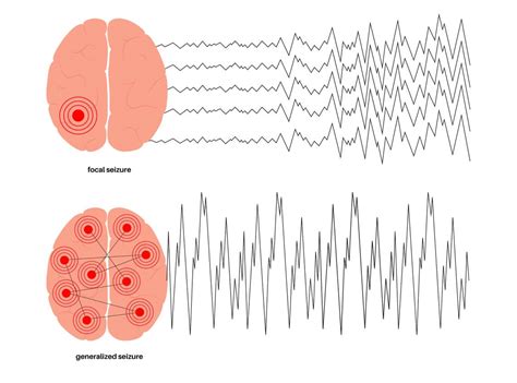 Focal vs Generalized Seizures: What's the Difference? - Care Options for Kids