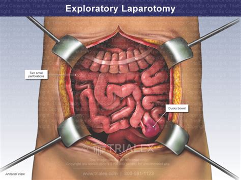 Exploratory Laparotomy - TrialQuest Inc.