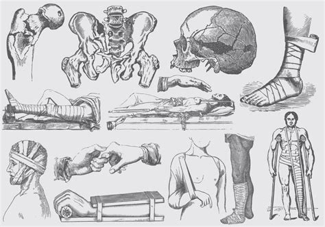 Gray Fracture Treatment Illustrations 128568 Vector Art at Vecteezy