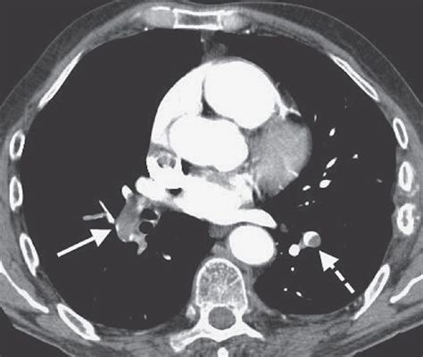 Pulmonary Vasculature Disease | Radiology Key